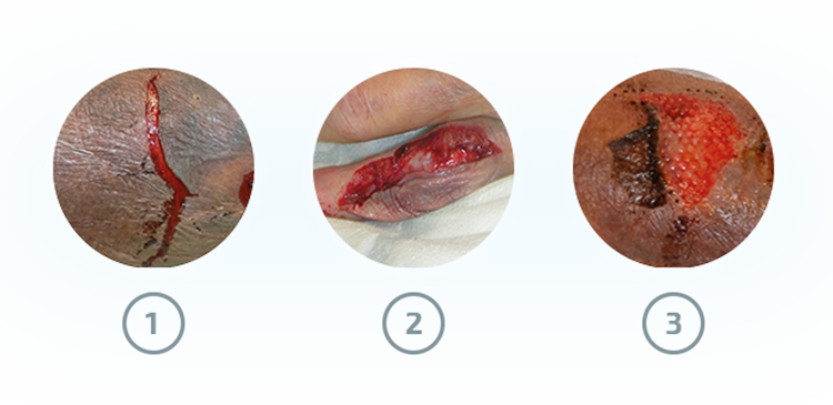 Image showing three types of skin tears wounds Image showing three types of skin tears wounds